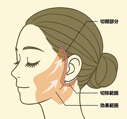 フェイスリフトの施術イメージ