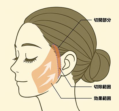 ストレートリフトのイメージ