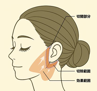 ワイドリフトのイメージ