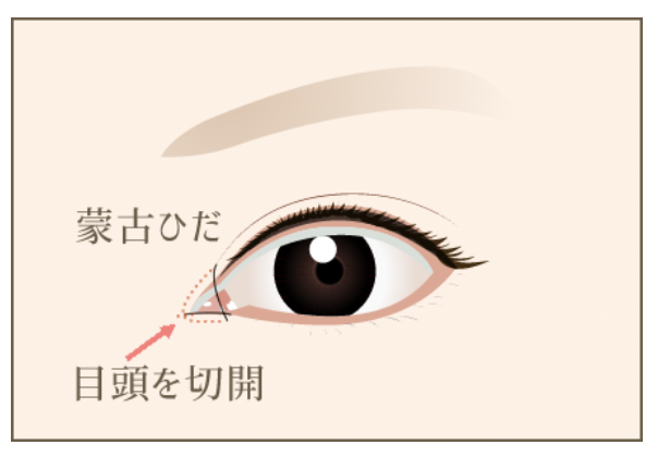 目頭切開のダウンタイムは？気になる経過や期間・過ごし方を知って不安を解消しよう