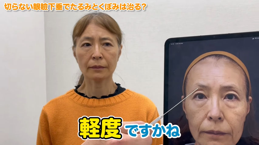 【くらママさん63歳の切らない眼瞼下垂】3ヶ月後の状態は？