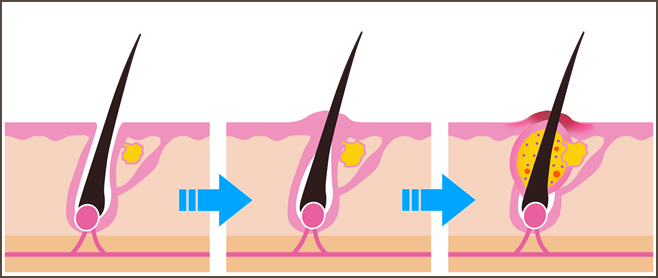 ニキビの原因