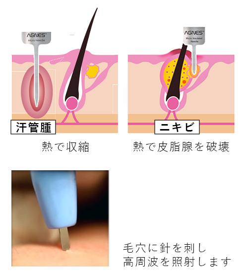 アグネスの仕組み