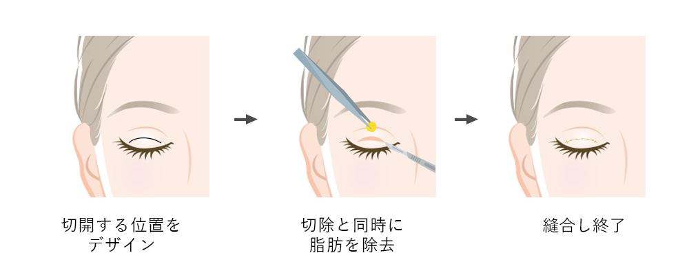 上まぶたのたるみ取り切開法