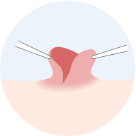 陥没乳頭乳管温存コンプリート法