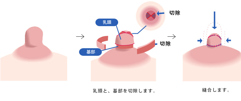 乳頭縮小術 高さ+直径縮小