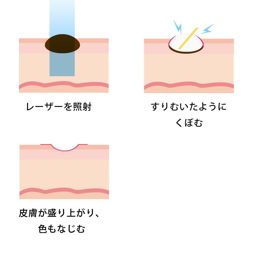 イボレーザー治療 CO2