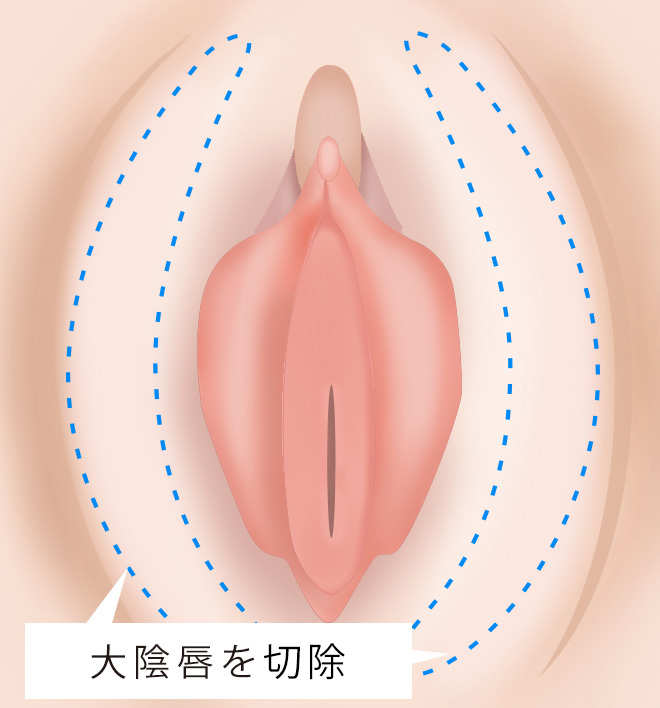 大陰唇縮小術