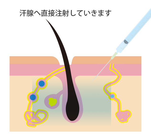 しわ取り注射法(わきが・多汗症)