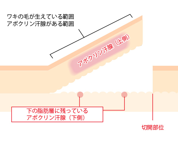 切開剪除(せんじょ)法 