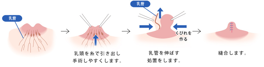 陥没乳頭 乳管温存法 中度の場合