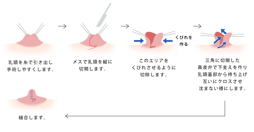 陥没乳頭 乳管温存法 重度の場合