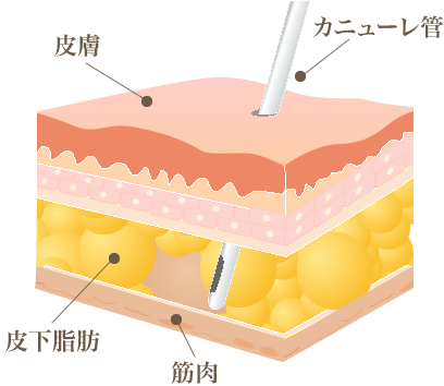 脂肪吸引