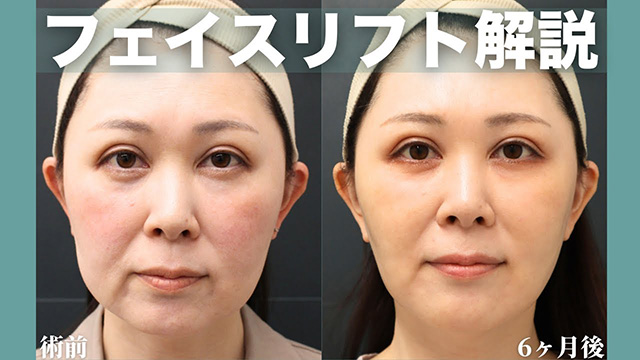 【フェイスリフト】リフトアップ施術をまるっと解説❗️