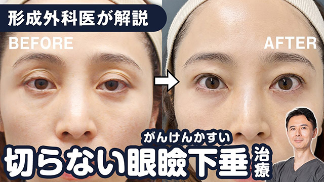 【形成外科医が徹底解説】切らずに済む眼瞼下垂治療