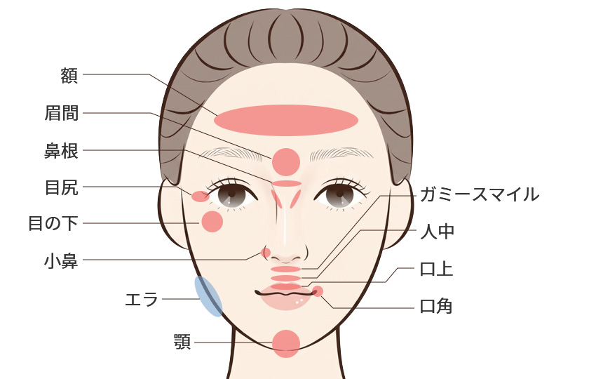 額・眉間・目尻など、筋肉の働きを調整する注射が適している表情じわの部位イメージ