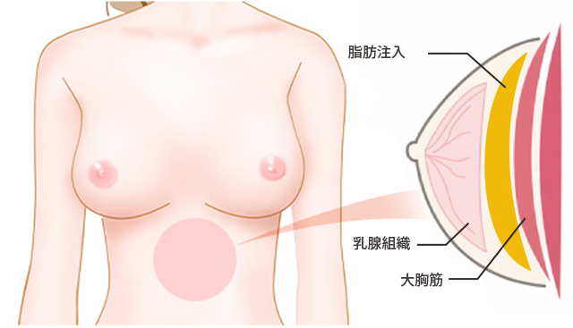 脂肪注入豊胸のイメージ