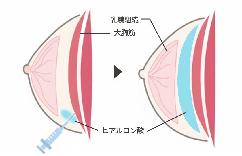 注入治療を注入して形を整えるイメージ