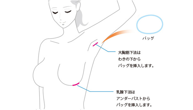 バッグ豊胸でバストの形とボリュームを整えるイメージ