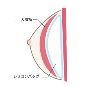 シリコンバッグ豊胸