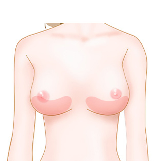 下垂やボリュームの落ちを整えたいイメージ