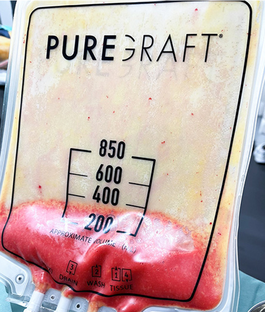 丁寧な注入設計のイメージ