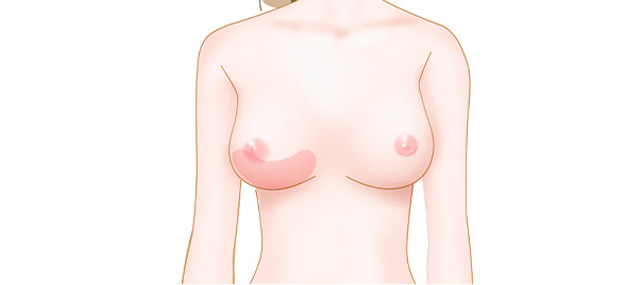 左右差のあるバストのイメージ