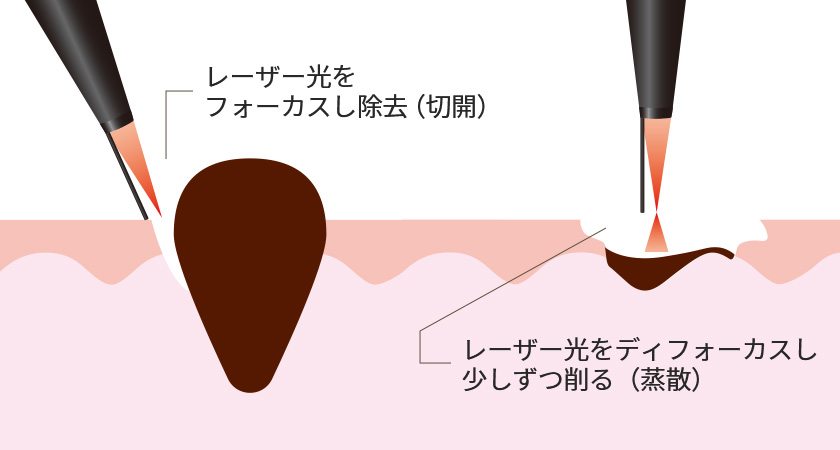 CO2レーザーの作用イメージ