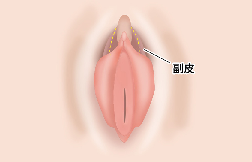 小陰唇と副皮の位置関係イメージ