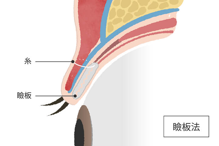 瞼板埋没法イメージ