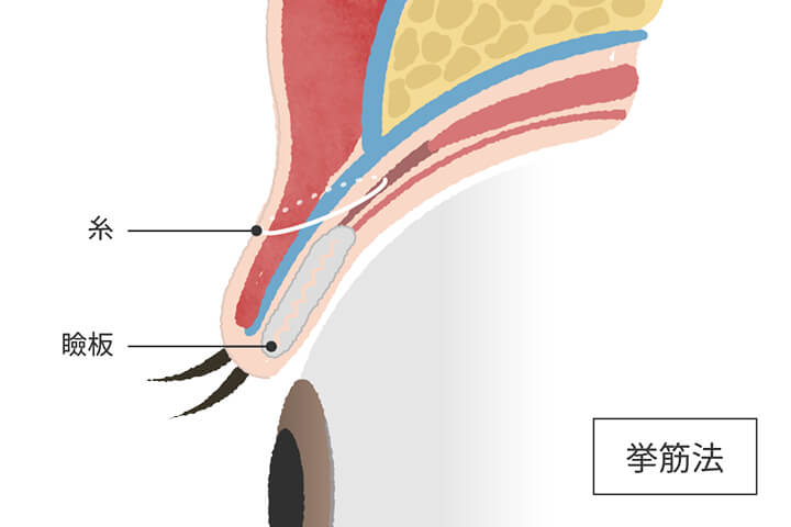 挙筋埋没法イメージ