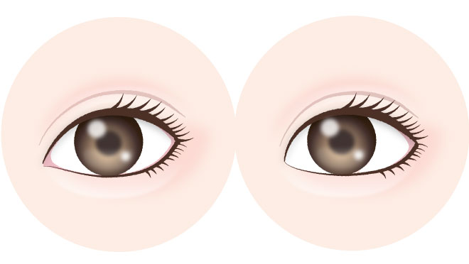 目頭・目尻切開をバランスよく併用して横幅を整える