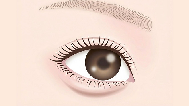 目の下のたるみ治療のイメージ