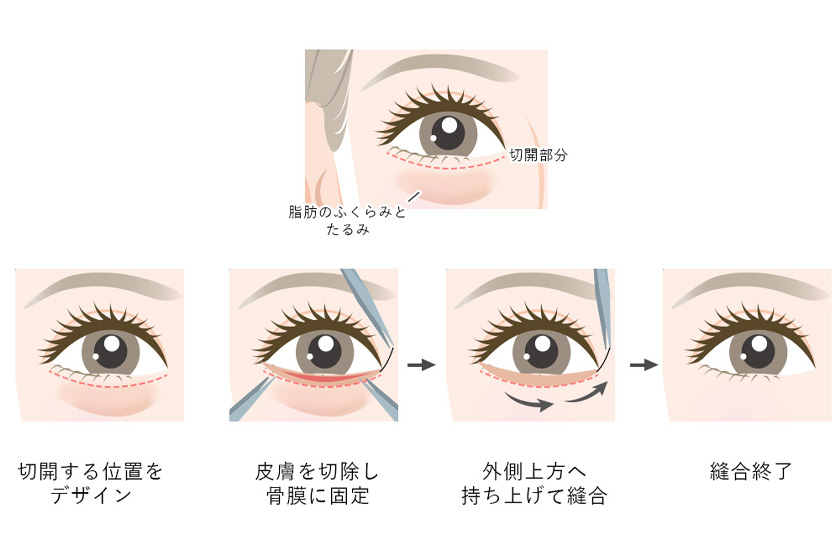 下眼瞼除皺・脂肪除去のイメージ
