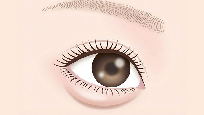 経結膜脱脂を優先するケースのイメージ