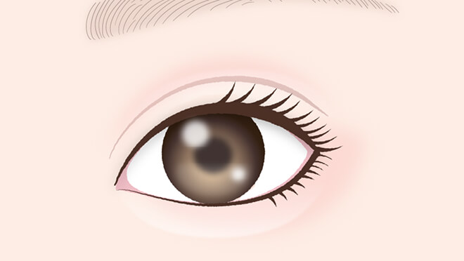 目頭切開と上眼瞼脱脂で平行二重・幅広二重に