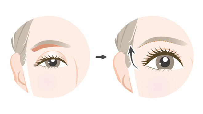 眉下切開・眼瞼下垂との違い