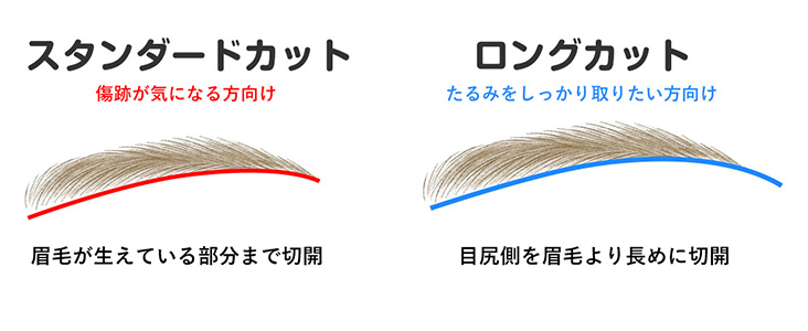 2つの眉下切開のタイプ