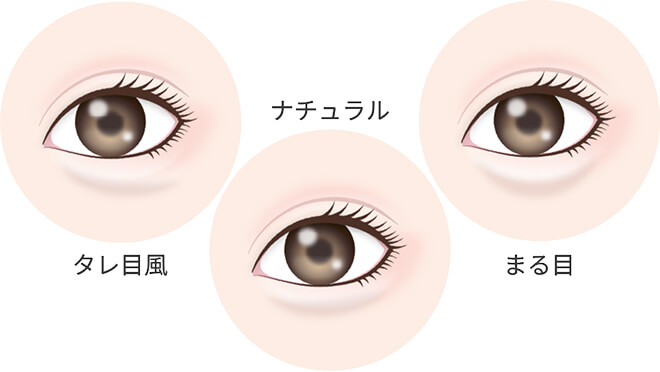 涙袋ヒアルロン酸