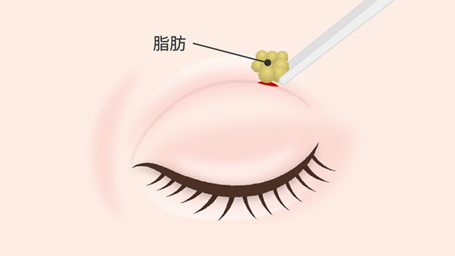 上眼瞼脱脂