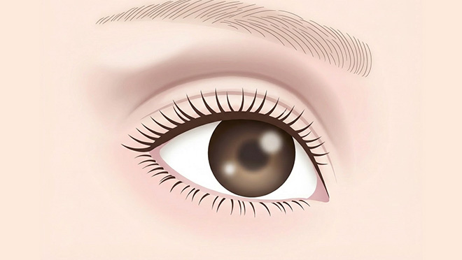 くぼみ取りとの違い