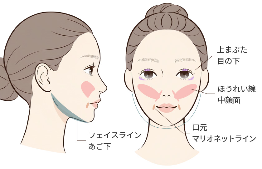 顔のたるみが出やすい部位のイメージ