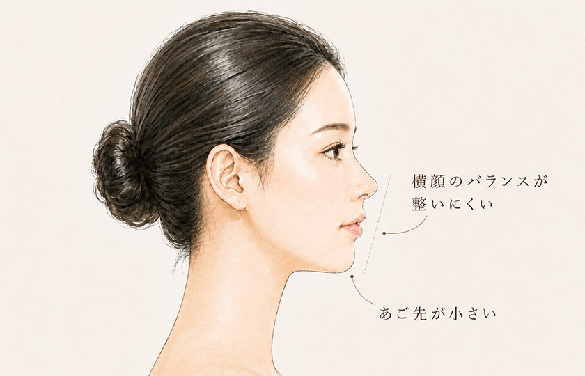 あご先が小さく、横顔のバランスが整いにくい状態のイメージ