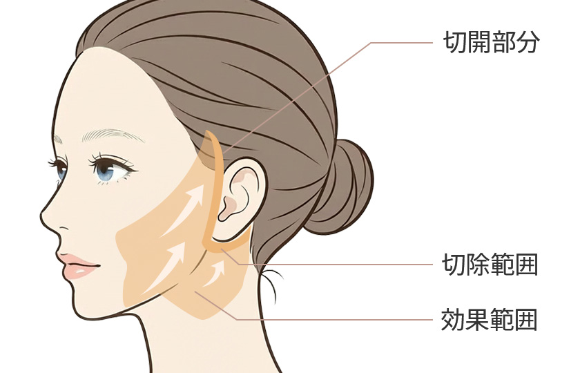 フルフェイスリフトのイメージ