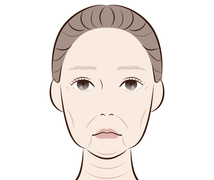 フェイスラインのたるみのイメージ
