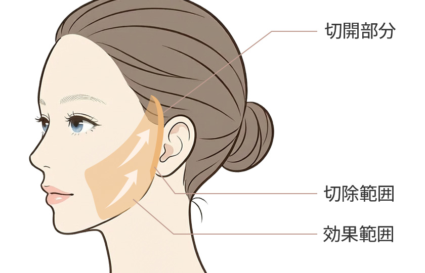 フェイスラインリフト（スタンダード）のイメージ