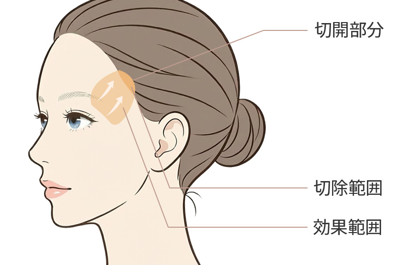 こめかみリフトのイメージ