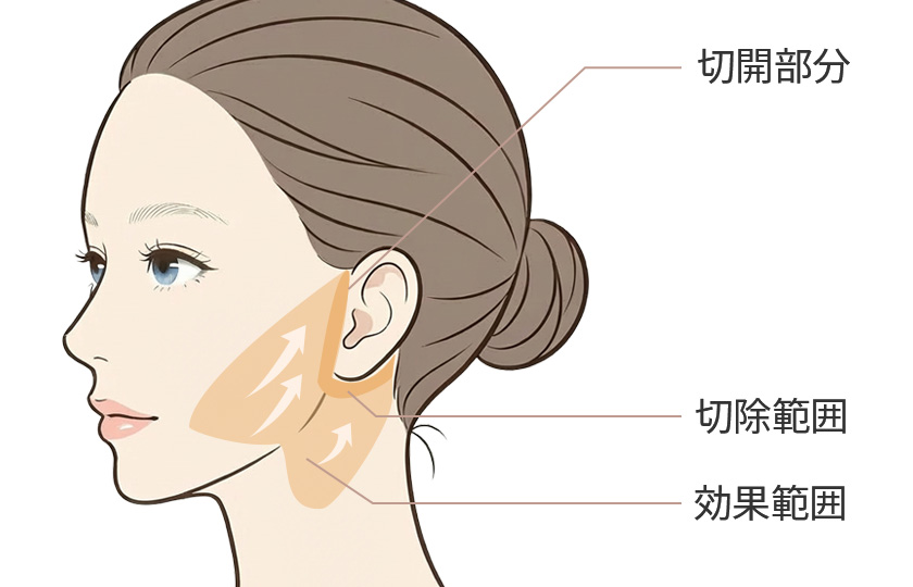 フェイスラインリフト（ワイド）のイメージ