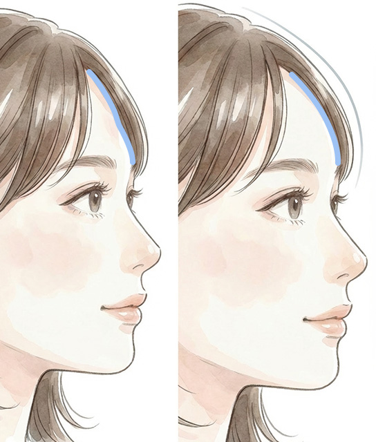 骨膜下に“楕円状”へ広げるフェア式デザイン注入イメージ