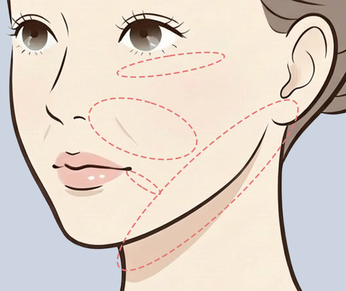 注入によるリフトアップ治療後のイメージ